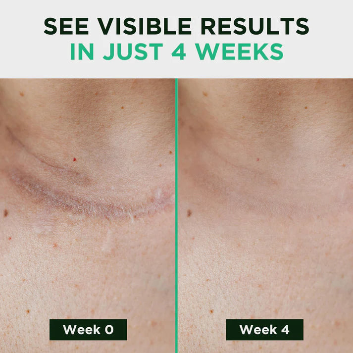 PureVa™ Silicone Scar Sheets