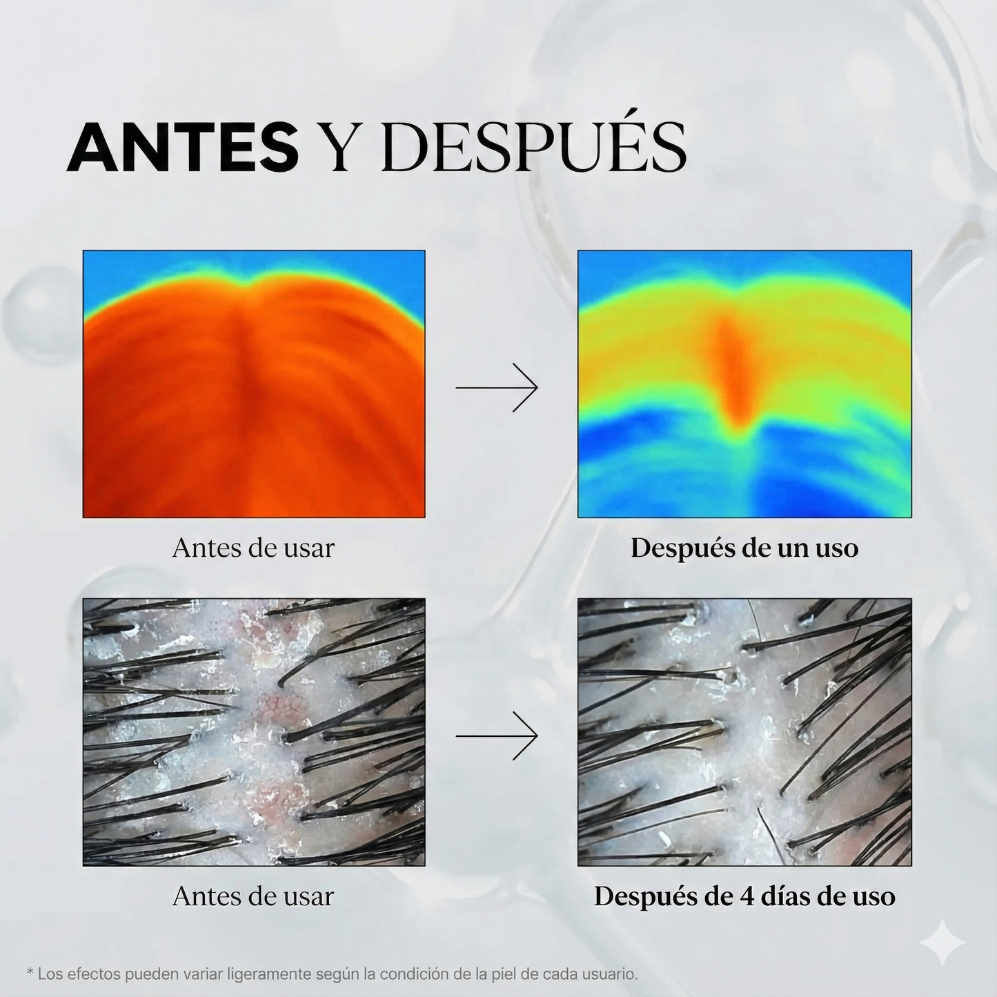 PureVa™ Reedle Shot Crecimiento Capilar